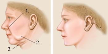 Alles über Facelift (Facelifting)