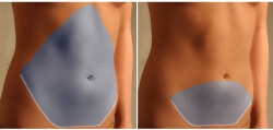 Volle oder Mini Bauchstraffung