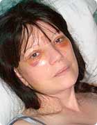 Schmerzen und Unwohlsein nach einem Facelifting Schmerzen und Unwohlsein nach einem Facelifting