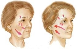 Methoden beim Facelift
