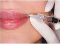 Lippenunterspritzung (Lippenaufspritzen/Unterspritzen)