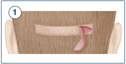 Eigenhaartransplantation mit STRIP-Methode