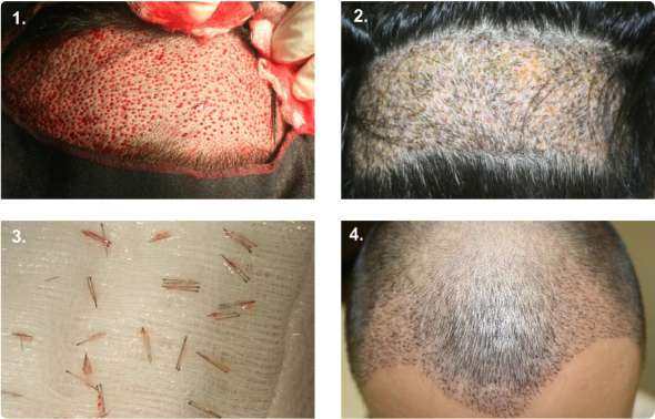 Haartransplantation mit der FUE (FUT)-Methode Schritt für Schritt